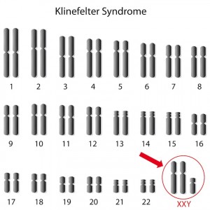 Klinefelter-Syndrom Karotyp 47xxy